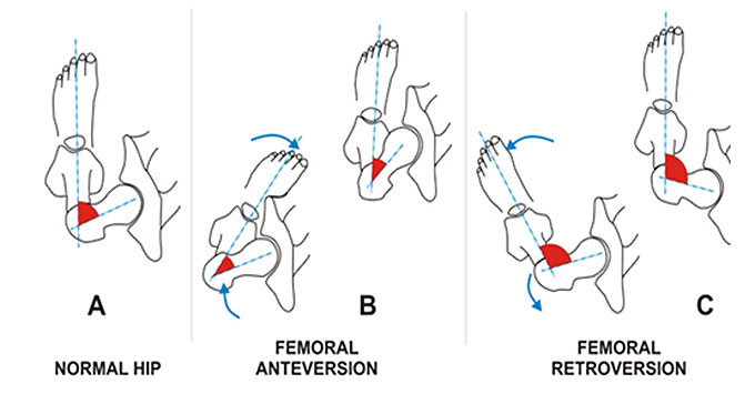 
	그림 6. 고관절의 위치에 따른 보행각도(발의 각도)의 변화
